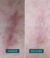 Produktbild 3 von 5, APRICOT Wiederverwendbare Narben Pads Silikonpad