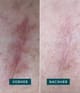 Produktbild 3 von 5, APRICOT Wiederverwendbare Narben Pads Silikonpad