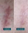 Produktbild 3 von 5, APRICOT Wiederverwendbare Narben Pads Silikonpad