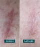 Produktbild 3 von 5, APRICOT Wiederverwendbare Narben Pads Silikonpad