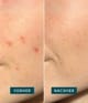 Produktbild 3 von 5, APRICOT Pickel Patches Pimple Patches