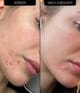 Produktbillede 4 af 5, The INKEY List Blemish Clearing Moisturizer Ansigtscreme