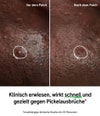 Produktbild 2 von 4, The INKEY List Hydrocolloid Invisible Pimple Patches