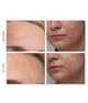 Produktbillede 4 af 5, FOREO KIWI™ Lysterapiapparat