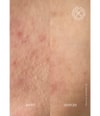 Produktbild 4 von 6, Acnemy Zitmask Gesichtsmaske