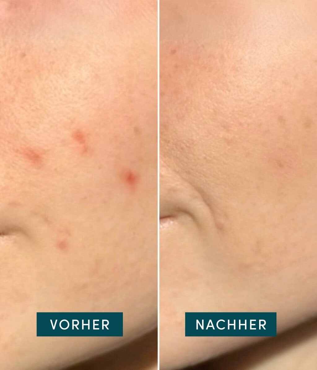 Produktbild 3 von 6, APRICOT Pickel Patches Pimple Patches