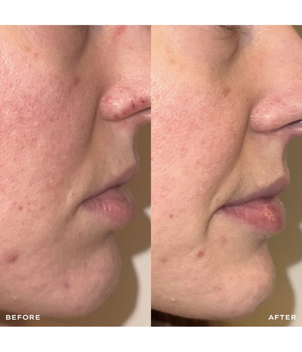 Сыворотка для лица Mantle The Spot Solution 10% Azelaic Acid Treatment Serum, для проблемной кожи, 30 мл — фото 3