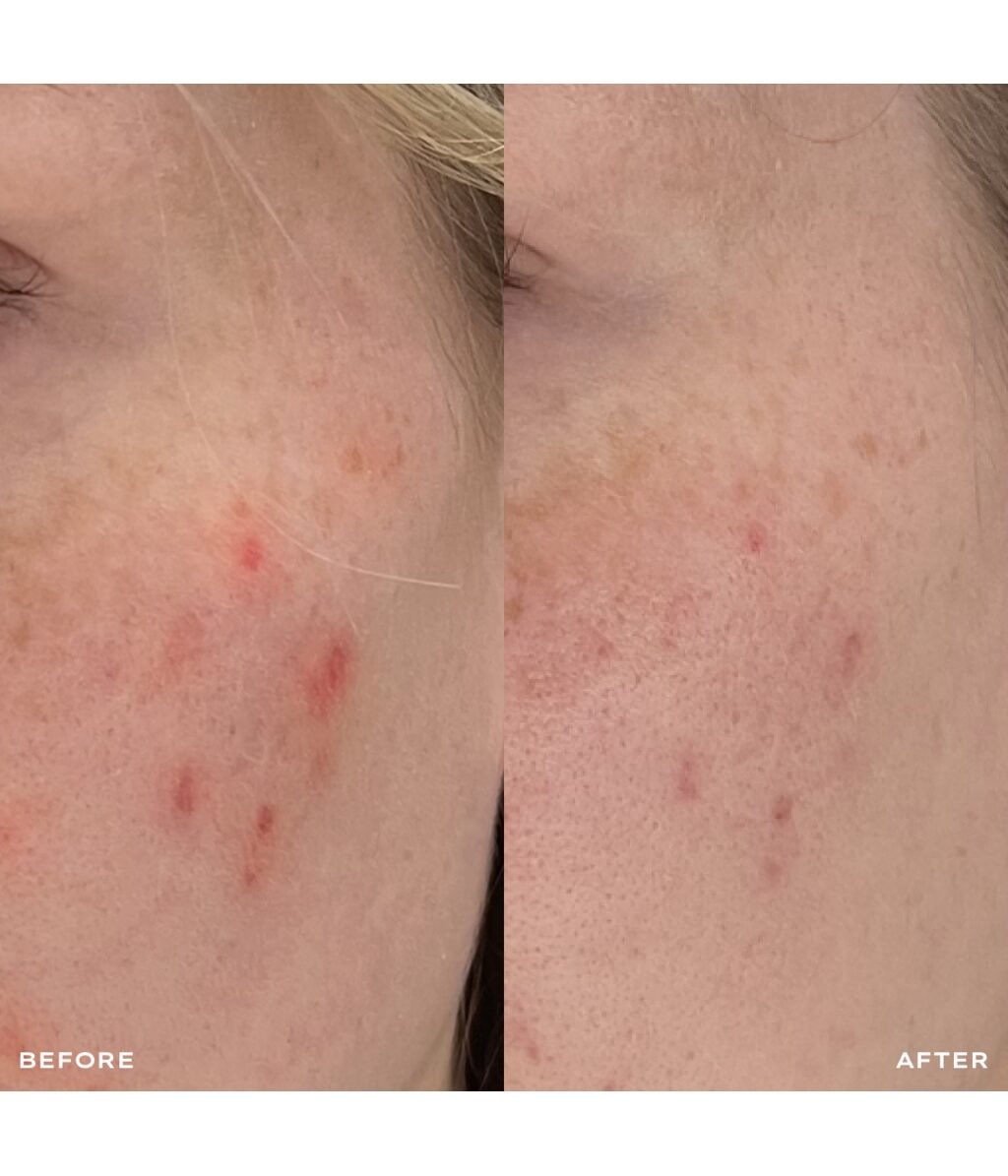 Сыворотка для лица Mantle The Spot Solution 10% Azelaic Acid Treatment Serum, для проблемной кожи, 30 мл — фото 4