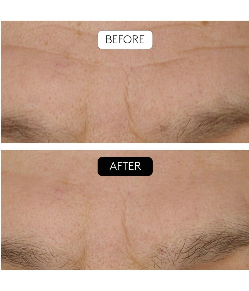 Сыворотка для лица Cocunat Clinical Beauty Filler Serum с микроигольным аппликатором, антивозрастная, для зрелой кожи, 5 мл — фото 4